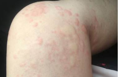 居然有人對冷過敏：這畫面美得不敢看